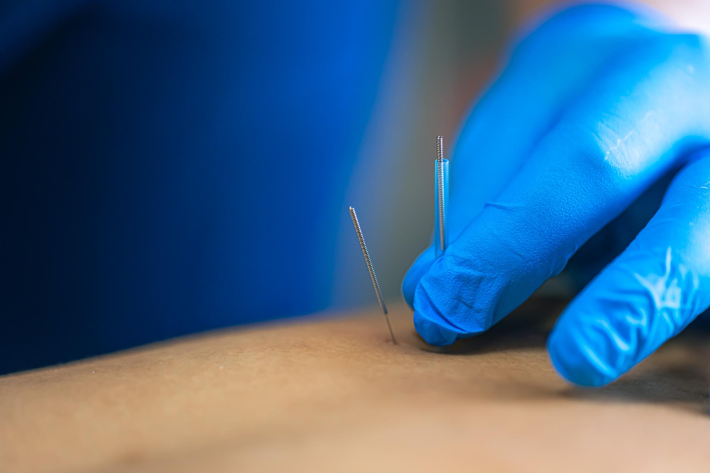 Dry Needling Juneau, AK